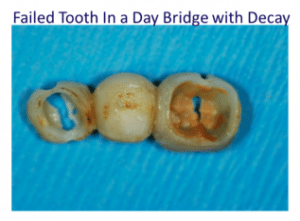 Pressed eMax porcelain crown with natural esthetics