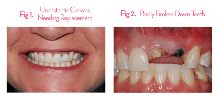 Patient with crowns not aesthetically pleasing