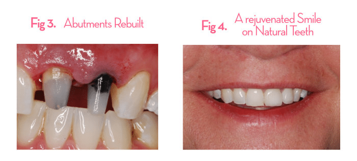 Tooth showing extensive decay beneath the crown