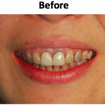 Patient initial presentation with dark discolored crowns and wide smile line