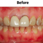 eMax pressed porcelain crown showing natural tooth-colored appearance