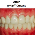 Final result showing naturally-looking eMax crowns with beautiful smile