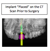 Anterior implant restoration showing natural-looking crown placement
