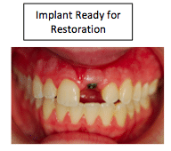 Demonstration of ideal emergence profile for anterior implant