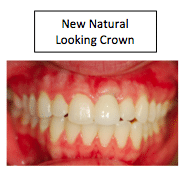 Final anterior implant restoration integrated with adjacent teeth