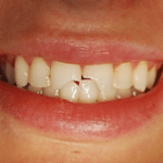 Before: Emergency Repair of Two Fractured Front Teeth