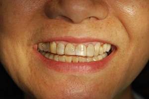 Before: Waiting For That Rejuvenated Smile!