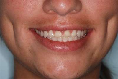 Before: Cosmetic Dentistry Case