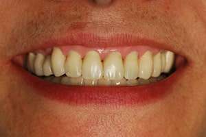 After: Waiting For That Rejuvenated Smile!