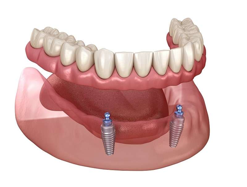 Mini Implant Overdenture