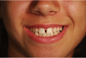 Before: Dental Implants for a Dramatic Cosmetic Smile Makeover