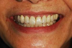 Patient rejuvenated smile after full restoration