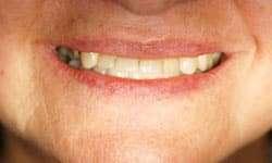 Before: Severe Restorative Breakdown