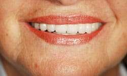 After: Severe Restorative Breakdown