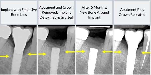Can a Failing Implant Be Salvaged or Replaced?