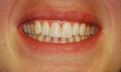 Before: The Single Anterior Crown