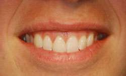 After: The Single Anterior Crown