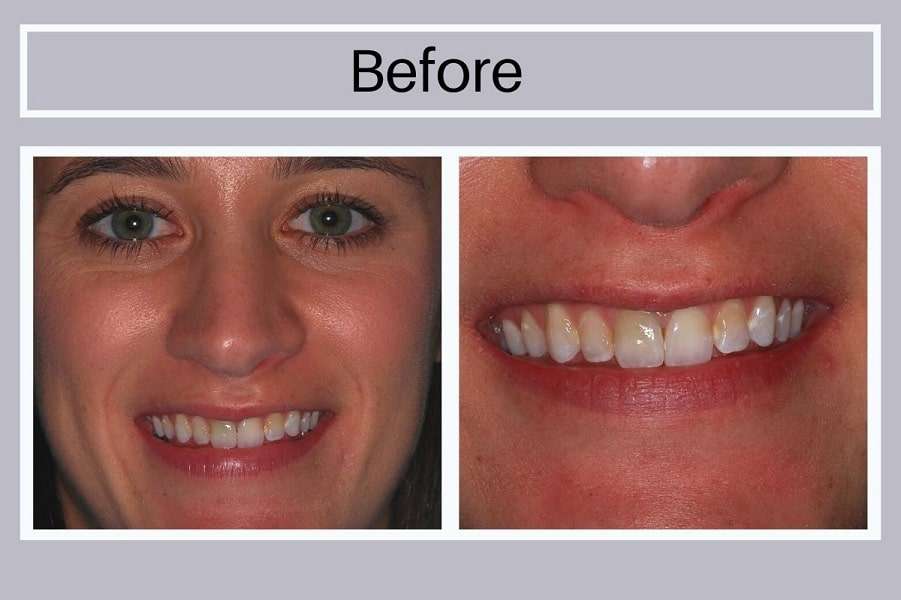 Smile Makeover Before