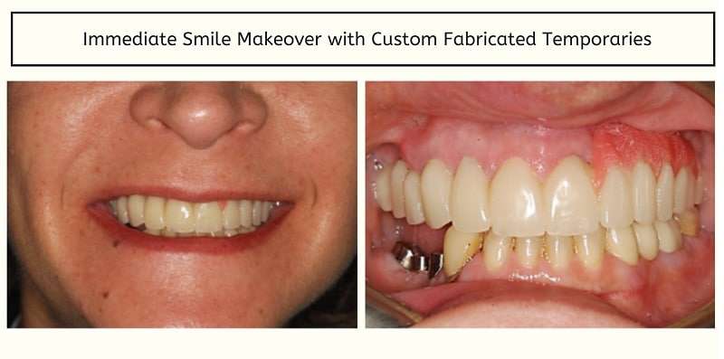 After: Smile Makeover with Dentition Reconstruction
