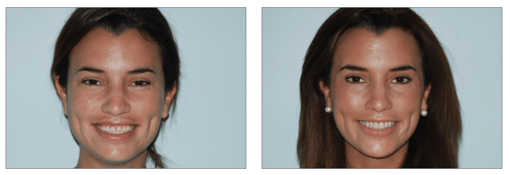 Tooth Grinding Patient