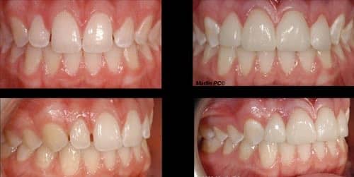 Marlin Veneers Before After Min