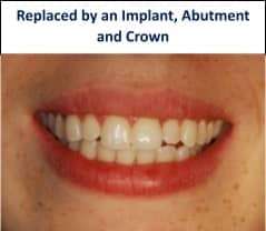 Before restoration showing missing front tooth