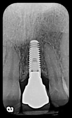 After restoration showing beautiful implant-supported crown