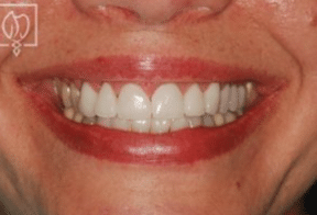 Zirconia crown example