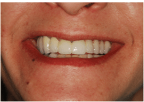 Porcelain fused to metal crown example