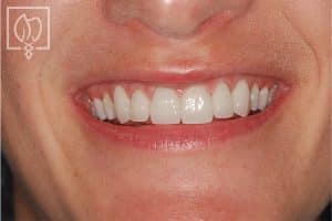 Rejuvenating Severely Mottled Discolored Teeth Dental Crowns Severely Discolored Dentition 1777 300X200