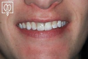 Rejuvenating Severely Mottled Discolored Teeth Dental Crowns Severely Discolored Dentition 4916 300X200
