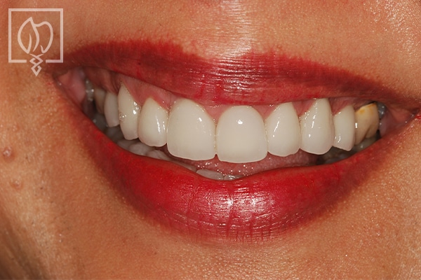 dental-crown-smile-makeovers-discolored-teeth-transformations-dental-crowns-severely-discolored-dentition--1818