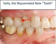 CT scan surgical guide for precise implant placement