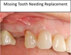 Missing tooth location requiring implant replacement