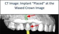 Ideal crown positioned in the implant space showing optimal placement