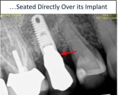 Final restored implant with natural-looking crown