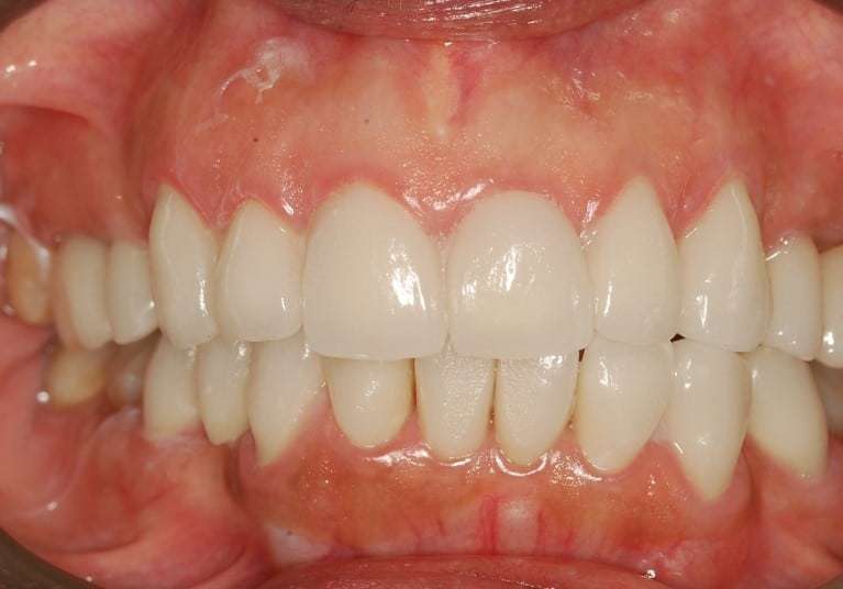 Say Goodbye to Stains with Our Approach to Crowns and Veneers