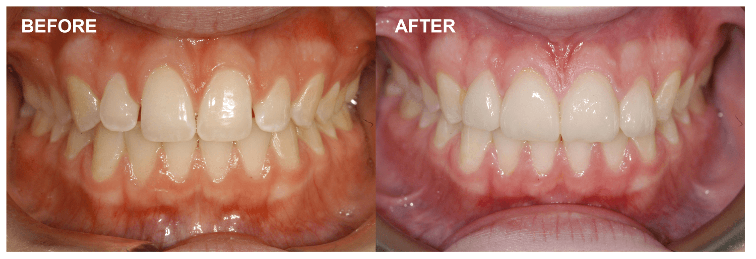 Common Reasons Why a Dental Veneer Fails