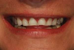 Before: Can Worn-Down Teeth Be Fixed or Do They Have to Be Replaced?