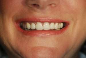 After: Can Worn-Down Teeth Be Fixed or Do They Have to Be Replaced?