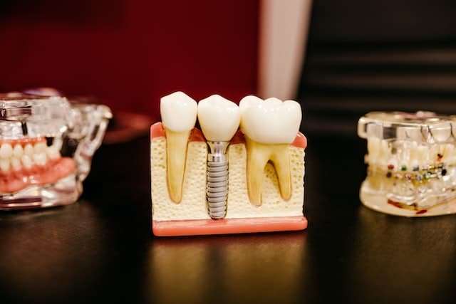 Common Factors That Can Limit the Success of Dental Implants