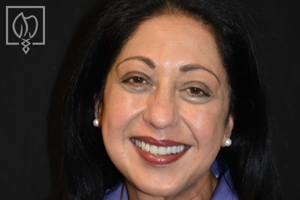 Dental Crown Smile Makeovers Discolored Teeth Transformations Dental Crowns Severely Discolored Dentition 7739