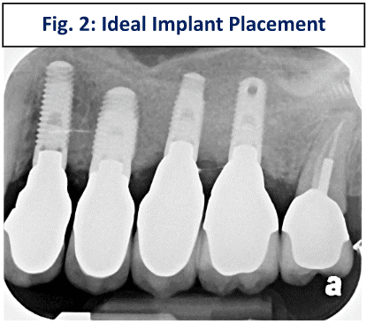 Ideal implant placement with proper positioning