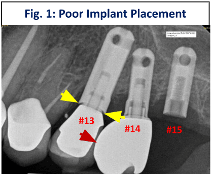Poor implant placement with inadequately close positioning