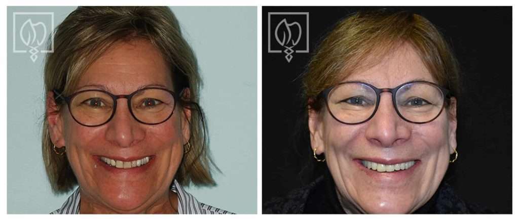 Our Patient Determined It Was Time for a Smile Makeover