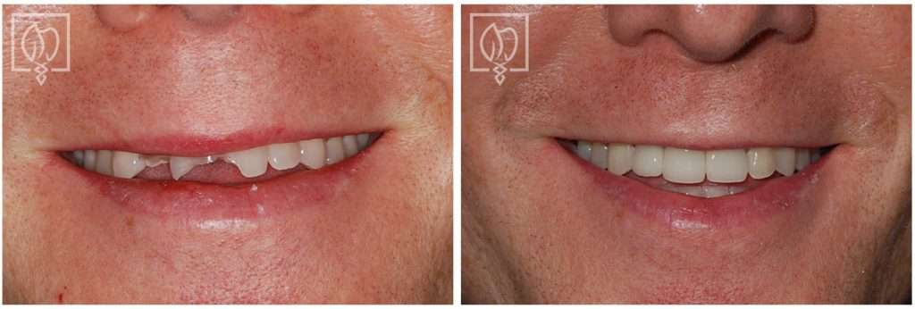 Our Patient Fell and Broke His Front Teeth. We Had Immediate Temporary Restorations Available the Next Day