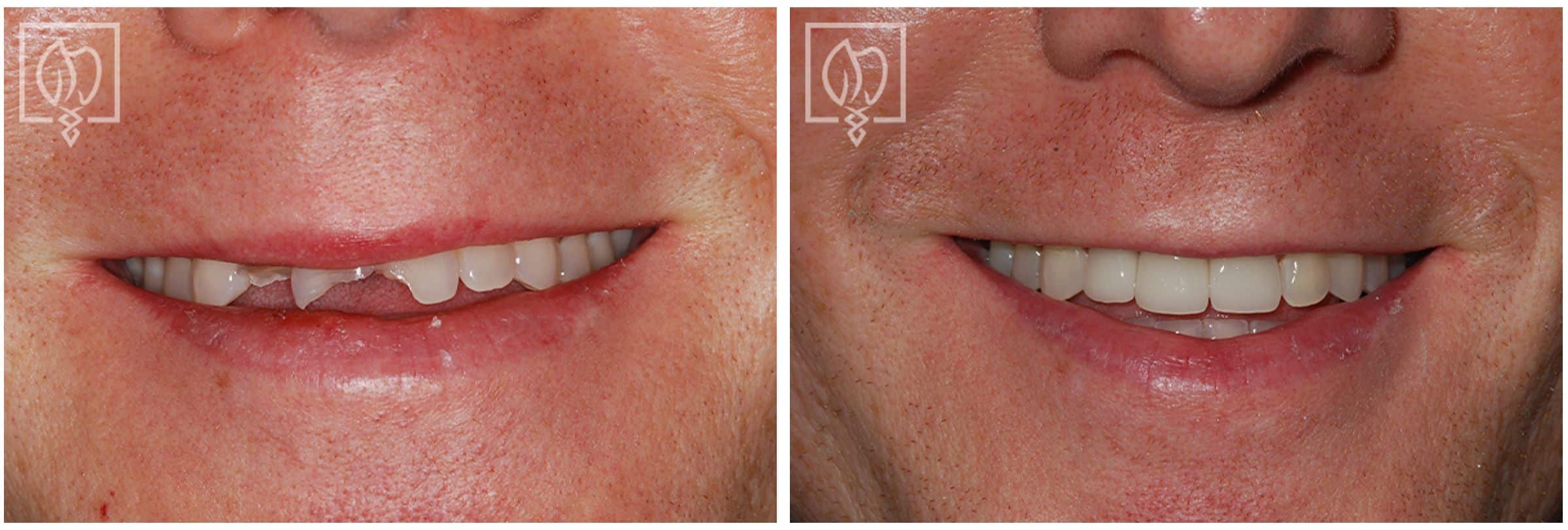 With Dental Emergencies, Can Cracked Teeth Be Repaired and Look Natural, Quickly?