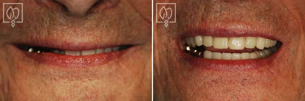 Restoring Multiple Old Dental Implants That Had Either Fractured or Failed