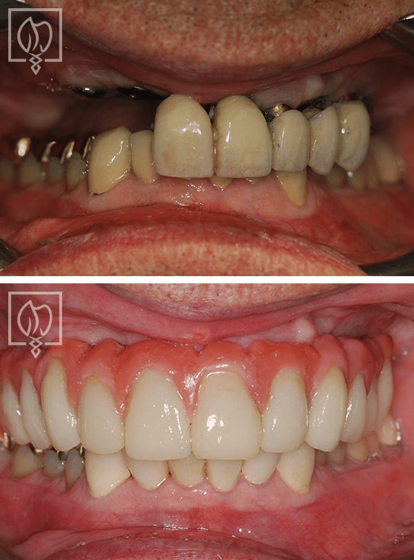 Implant Reconstruction 1862 Before After 2