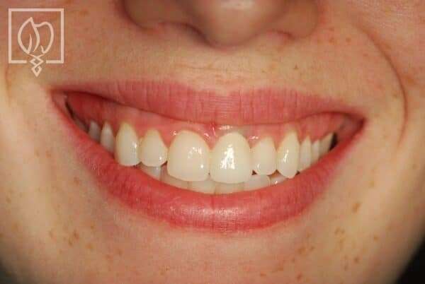 Why Do Some Dental Implants Last Longer Than Others?